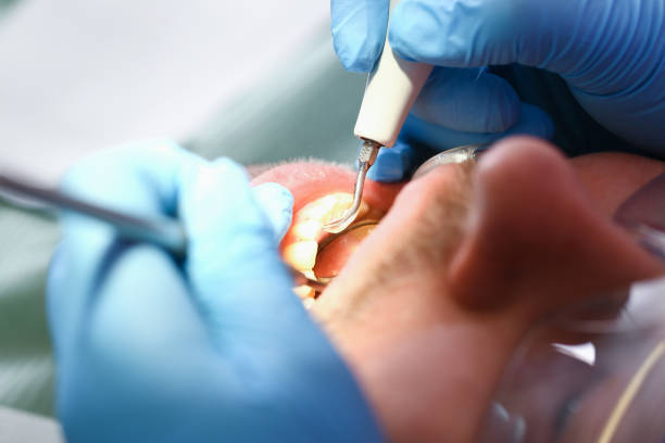 Best Knocked-Out Tooth (Avulsed Tooth) Treatment in Corsicana, TX